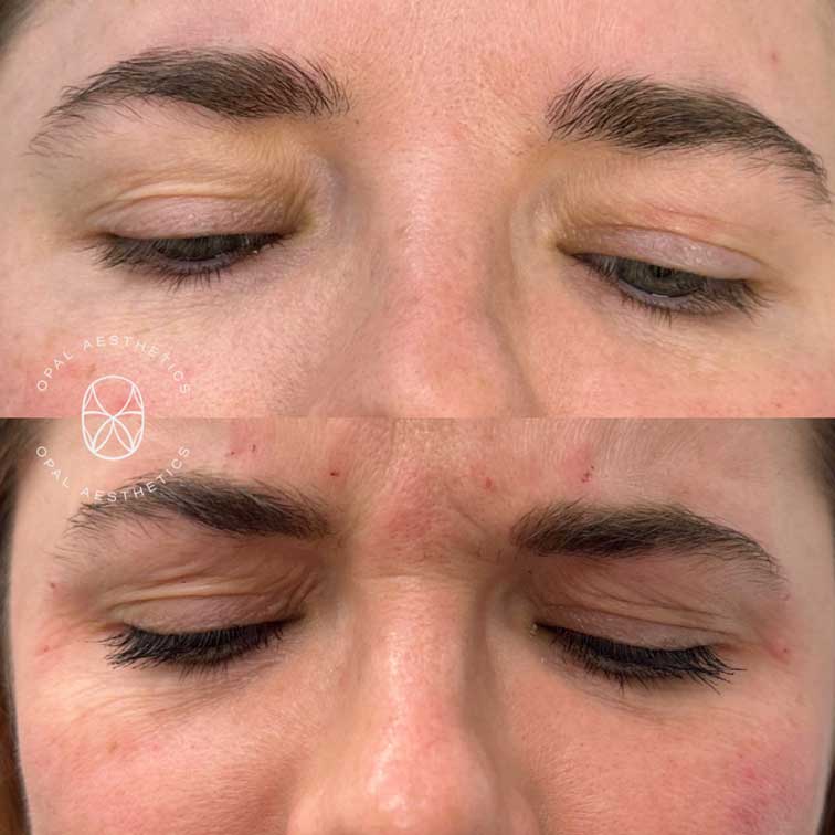 Before and after Botox at Opal Aesthetics Bakersfield