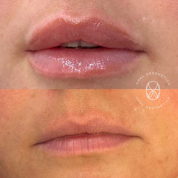 Before and after Lip Enhancement With HA Filler at Opal Aesthetics Bakersfield