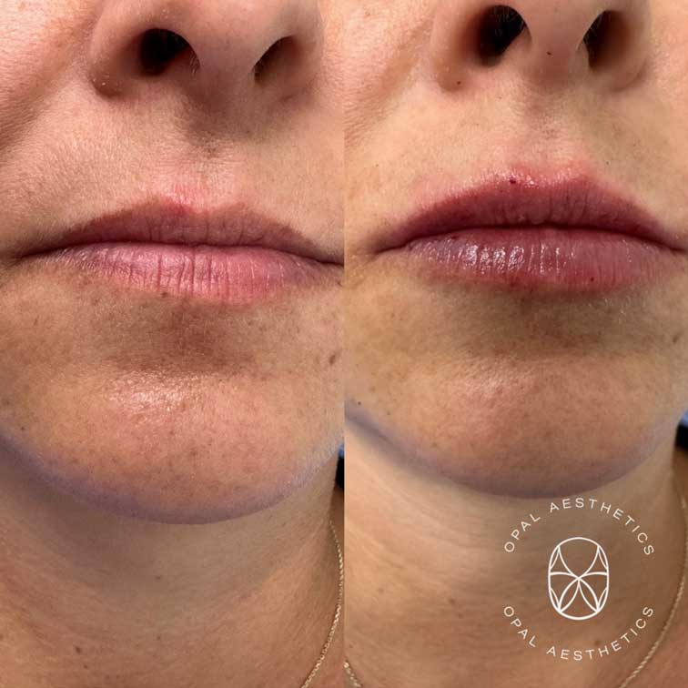 Before and after Lip Hydration With HA Filler at Opal Aesthetics Bakersfield