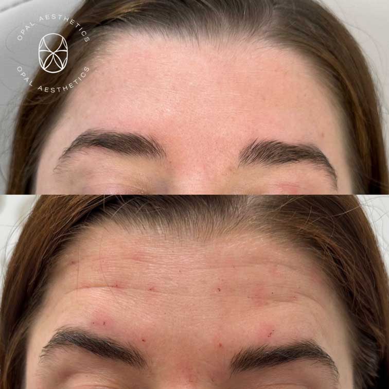 Before and after Botox at Opal Aesthetics Bakersfield