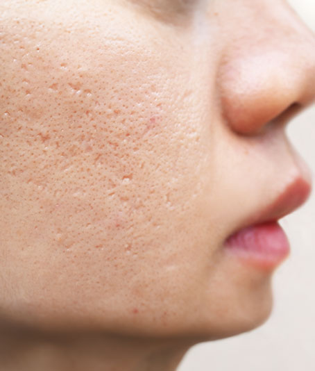 Acne & Acne Scars treatment in Bakersfield