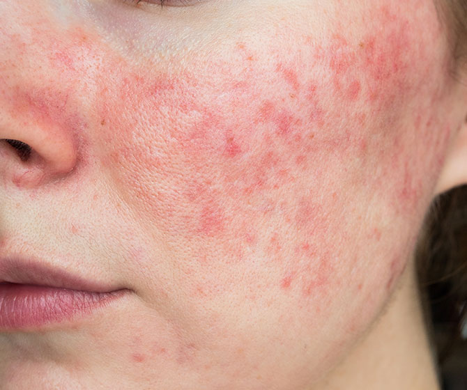 Rosacea & Facial Veins treatment in Bakersfield