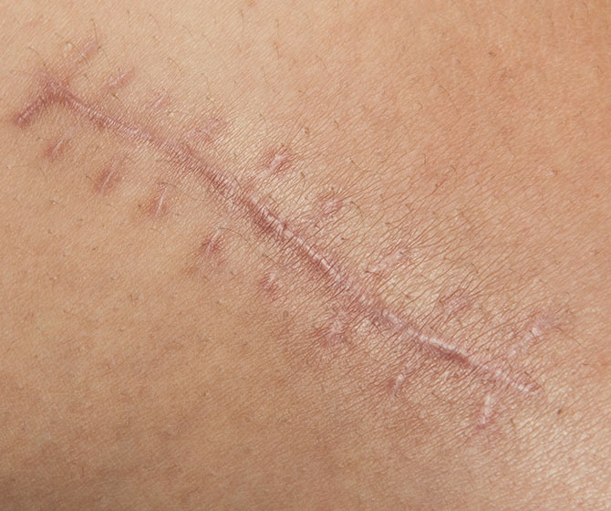 Stretch Marks & Scars treatment in Bakersfield