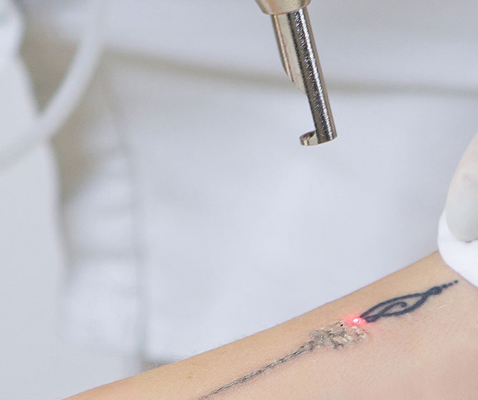 Tattoo Removal treatment in Bakersfield