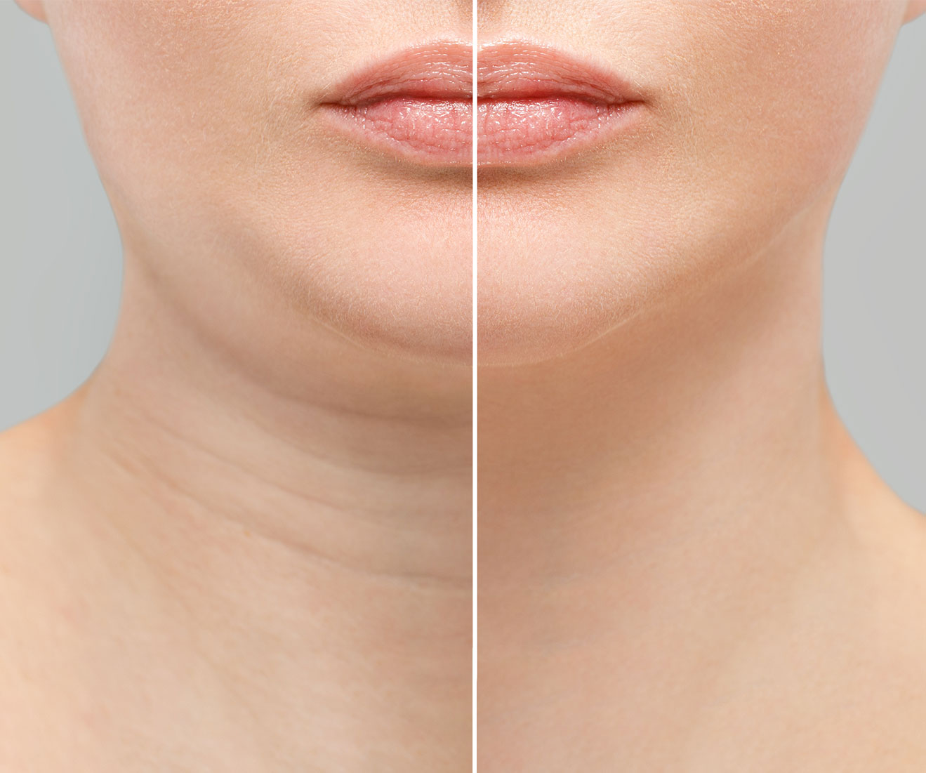 Kybella treatment at Opal Aesthetics