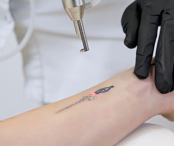 Laser Tattoo Removal at Opal Aesthetics in Bakersfield
