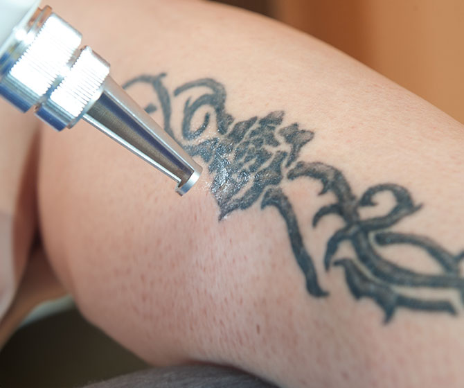 Laser Tattoo Removal treatment at Opal Aesthetics
